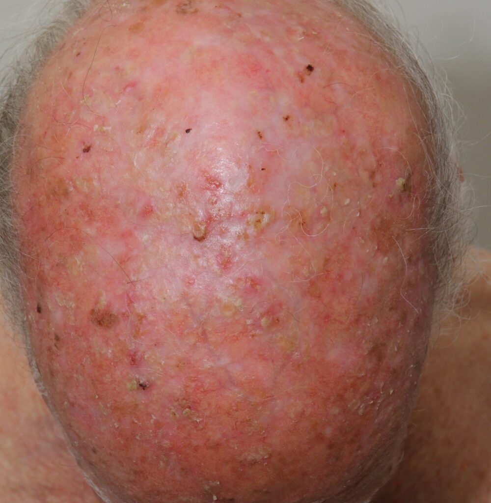 Photo of actinic field damage on the scalp.