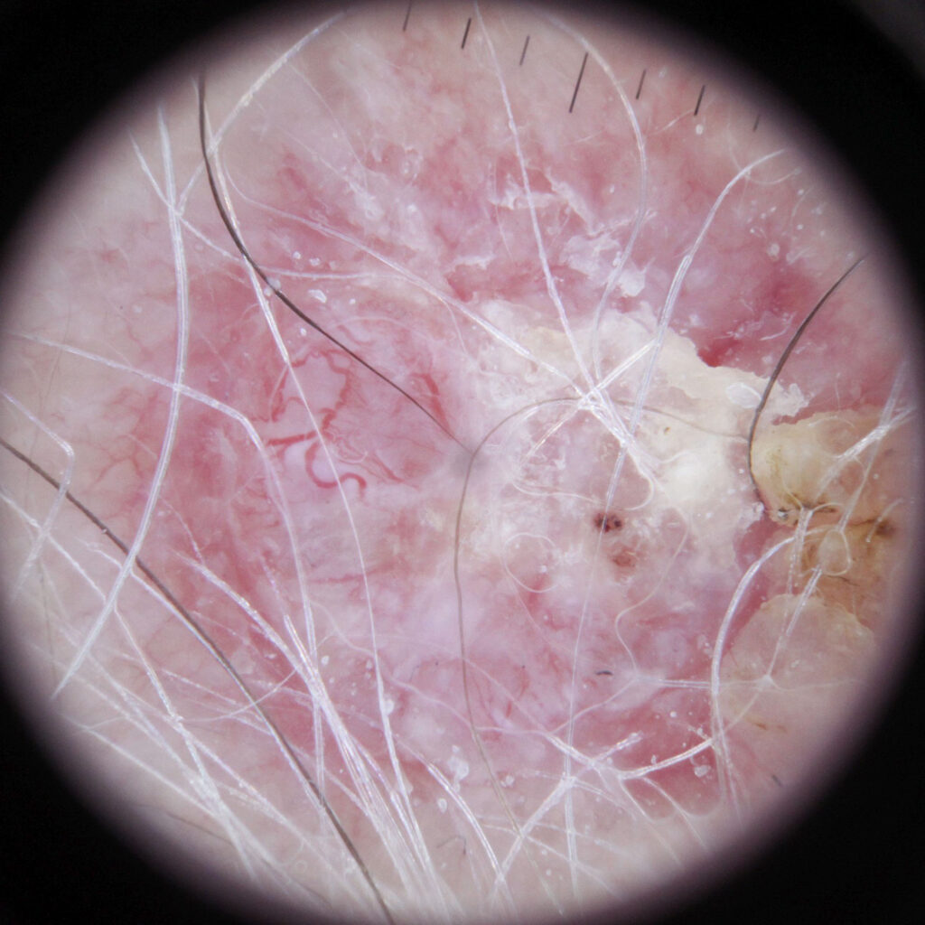 Dermoscopy of basal cell carcinoma (BCC) skin cancer.