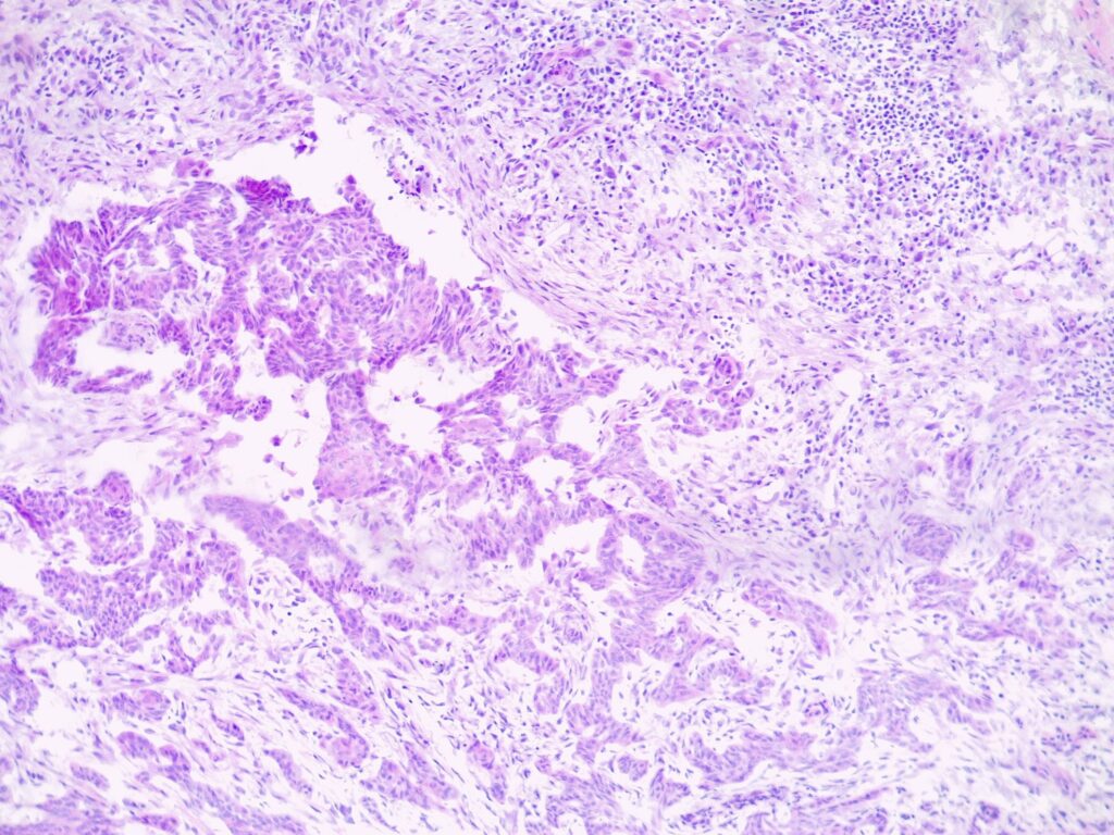 Histology of infiltrative basal cell carcinoma (BCC)