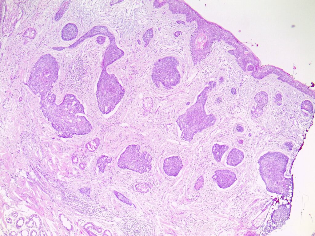 Histology of nodular basal cell carcinoma (BCC)