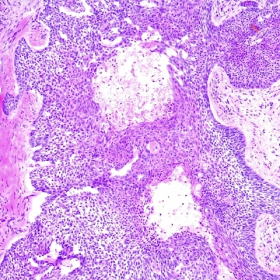 Histology of nodular basal cell carcinoma (BCC) at 10x magnifcation