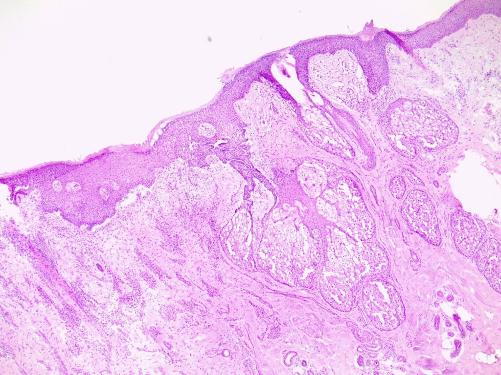 Histology of superficial basal cell carcinoma (BCC)