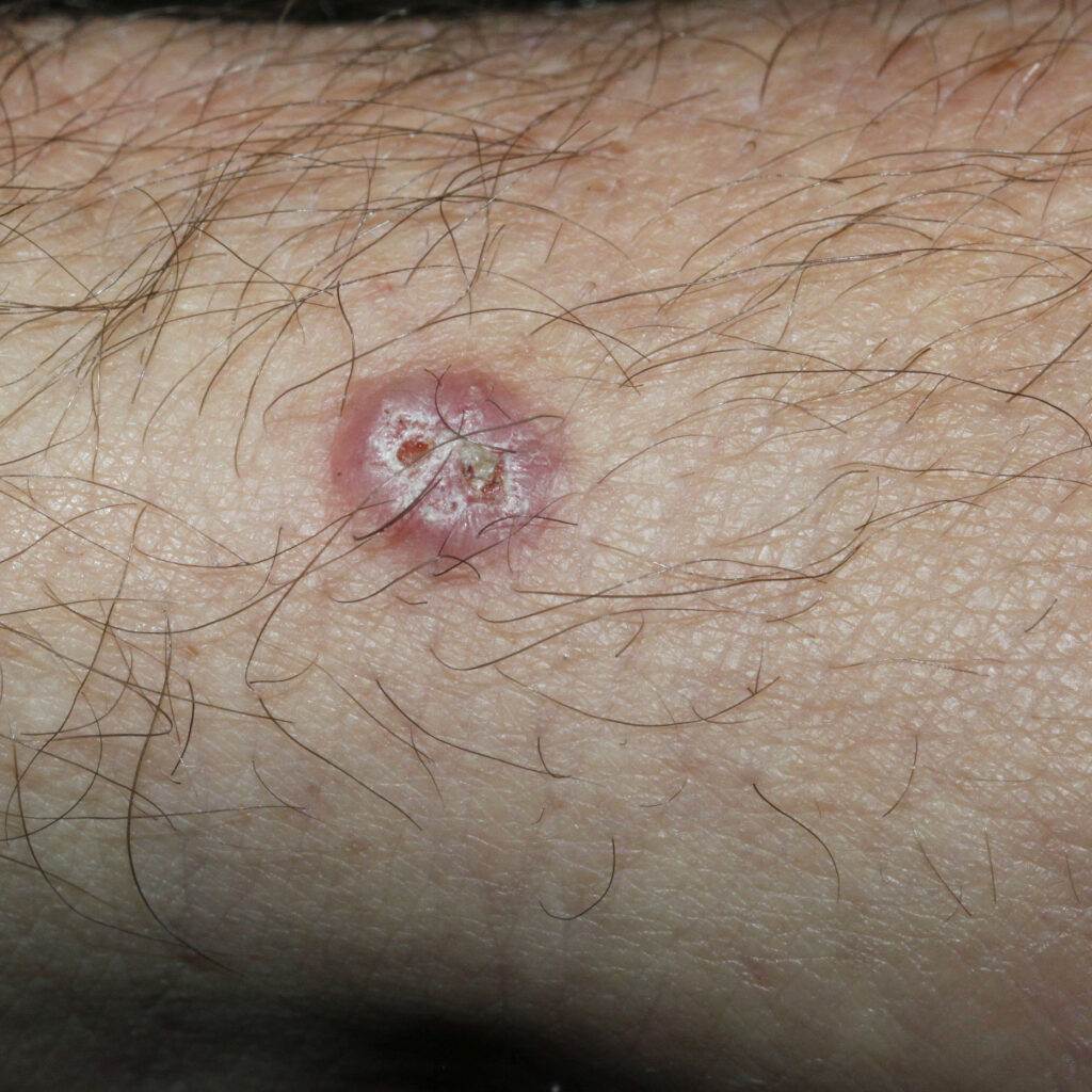 Clinical photo of a missed basal cell carcinoma (BCC) on the arm