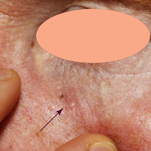 Clinical photo of a missed basal cell carcinoma (BCC) on the cheek