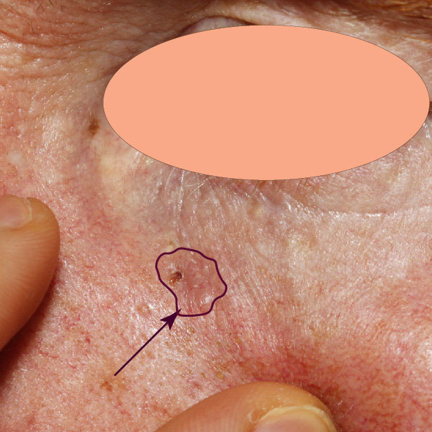 Clinical photo of a subtle basal cell carcinoma (BCC) skin cancer on the cheek with a marked border.