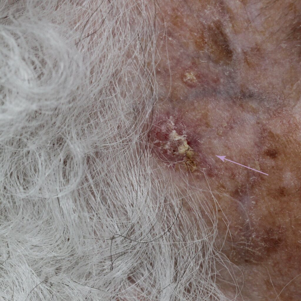 Clinical photo of basal cell carcinoma (BCC) skin cancer on the temple.