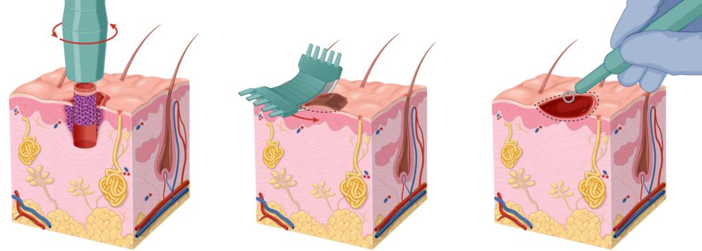 Diagram comparing different biopsy techniques - punch, shave, curettage