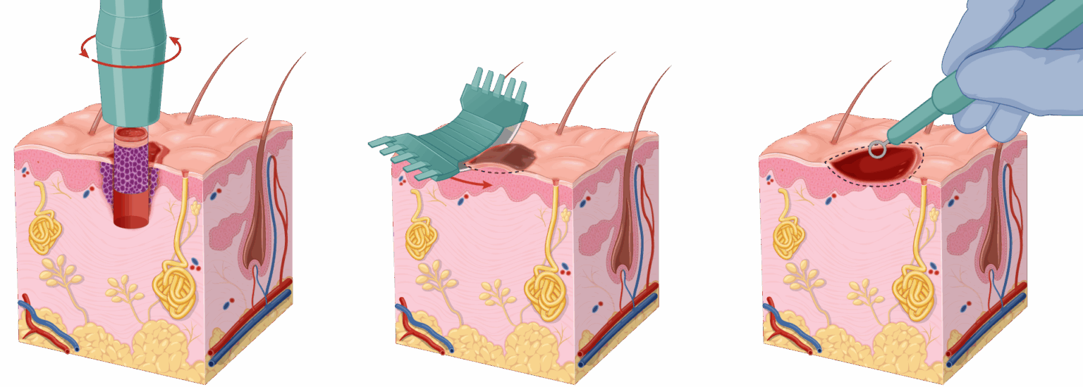 Basal Cell Carcinoma The Definitive Guide Skintel