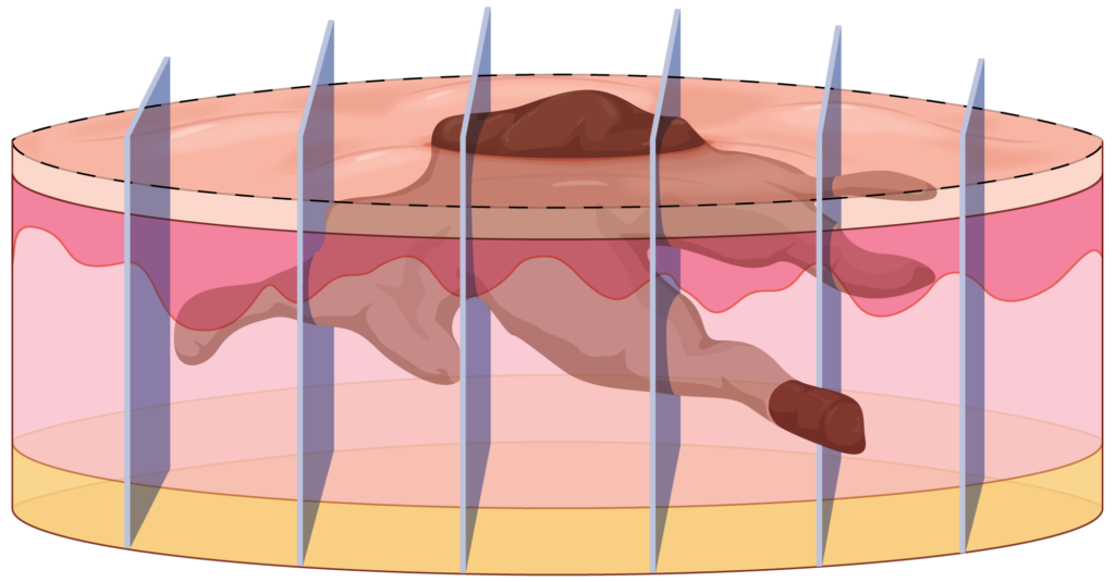 Diagram of pathology breadloafing showing missed skin cancer