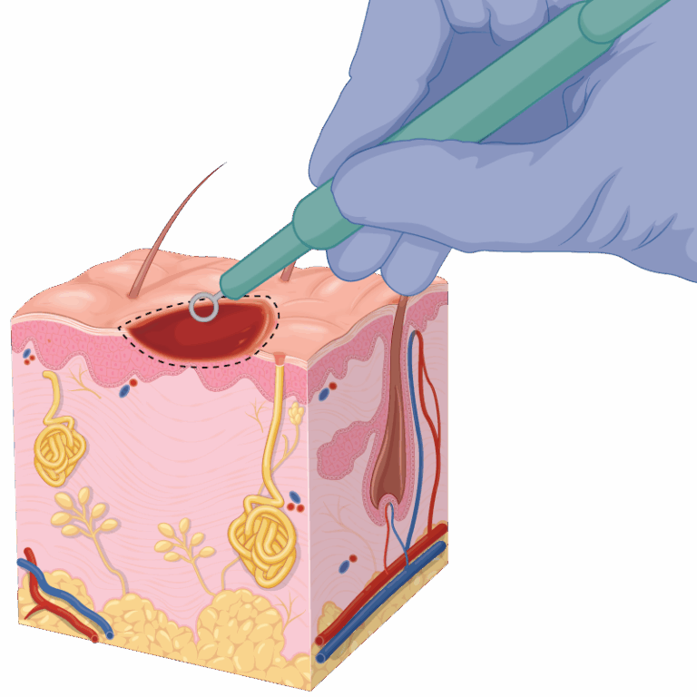 Expert Curettage for Lesion Removal Skintel