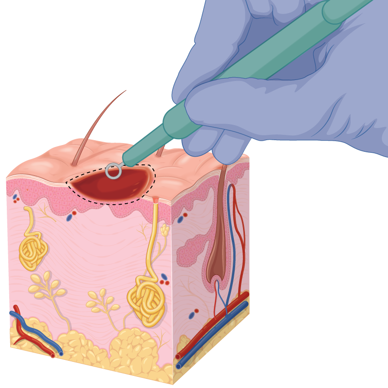 Diagram of a curettage skin biopsy.