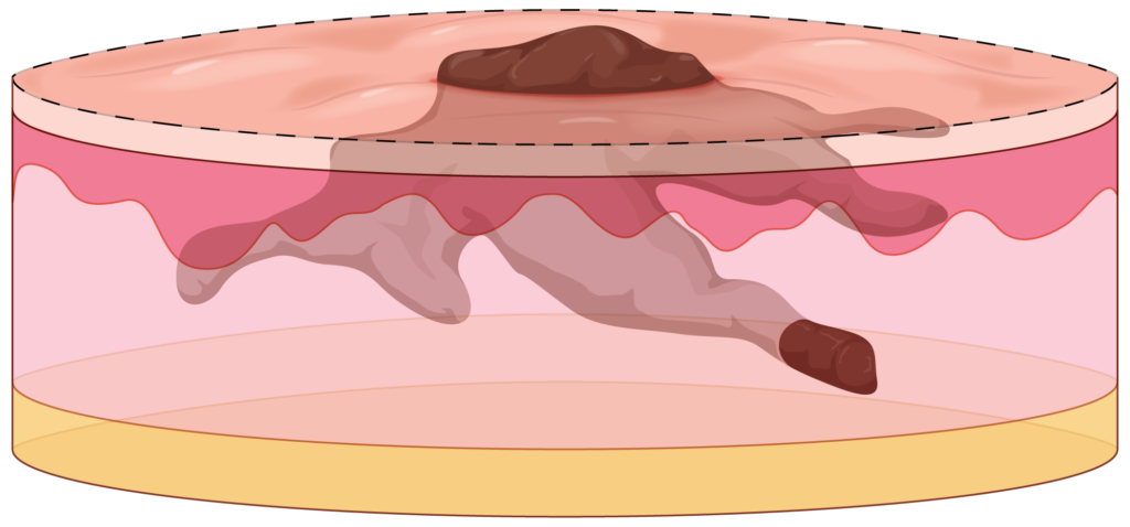 Diagram of incomplete excision in 3 dimensions