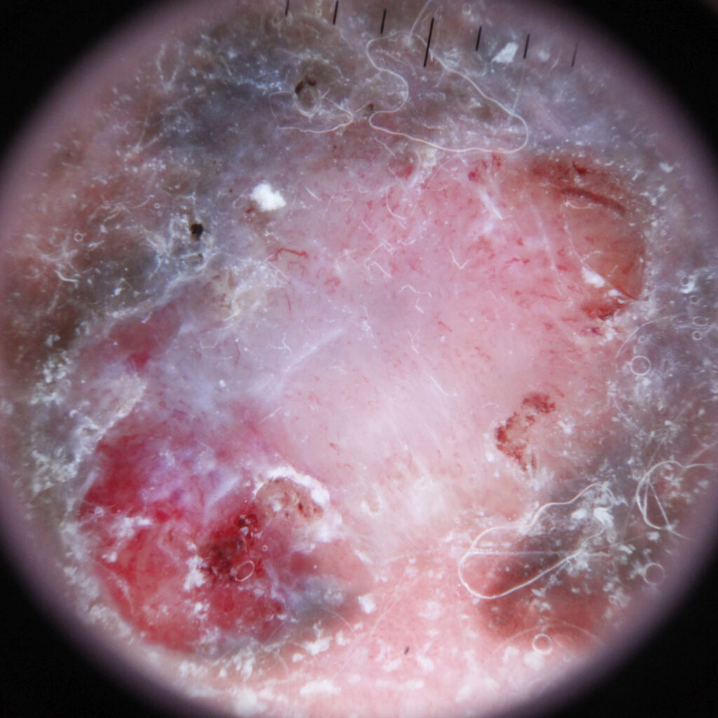 Photo of melanoma dermoscopy under a dermatoscope.