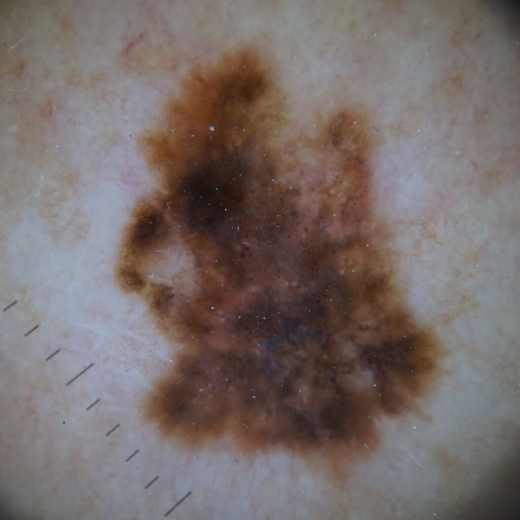 Photo of melanoma dermoscopy