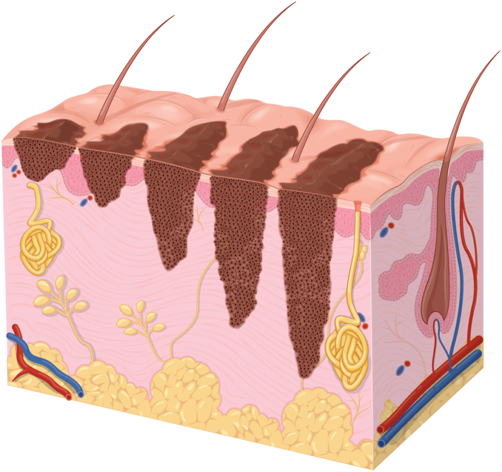 Diagram of different melanoma depths