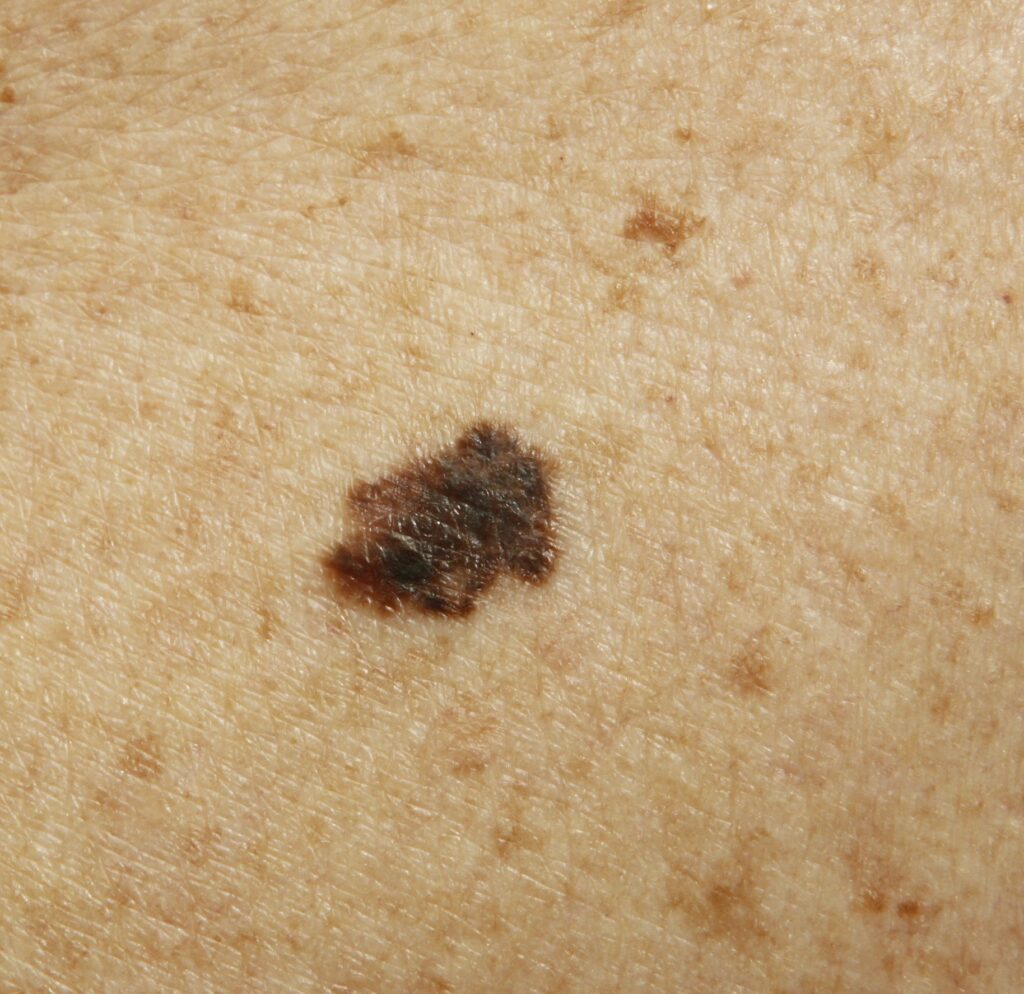 Clinical photo of melanoma skin cancer.