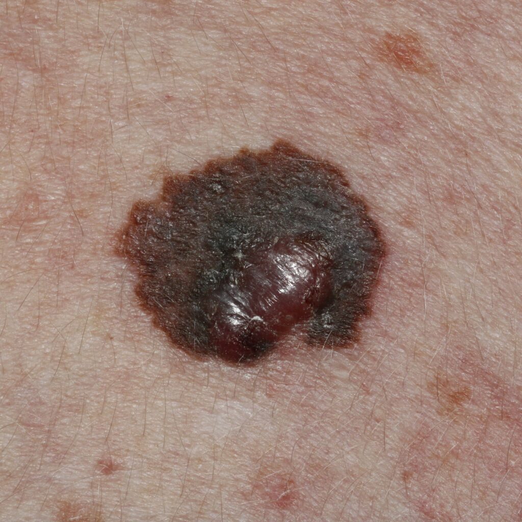 Clinical photo of melanoma