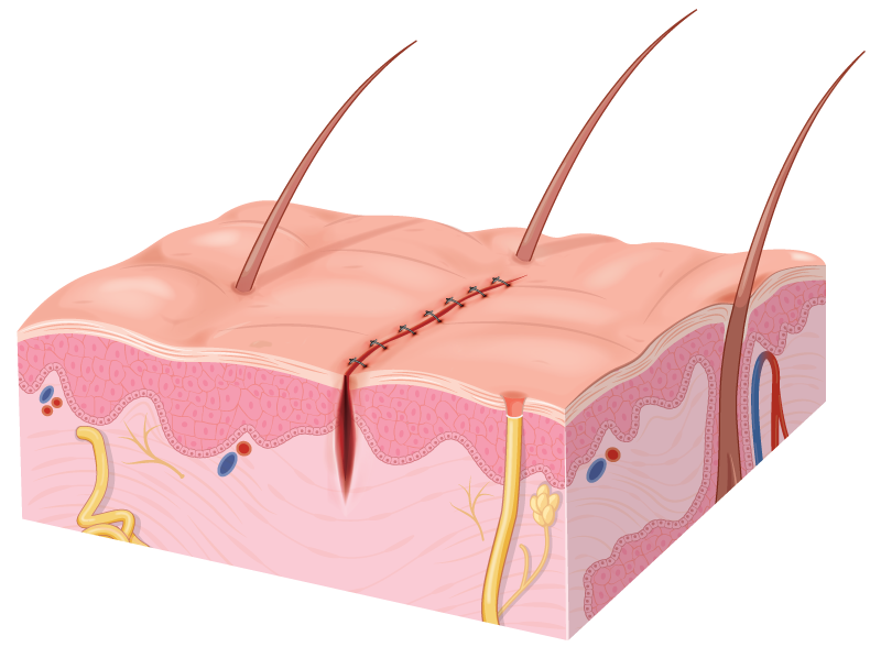 Diagram of Mohs surgery repair