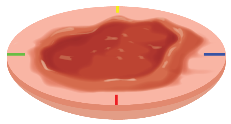 Diagram of Mohs surgery specimen removal