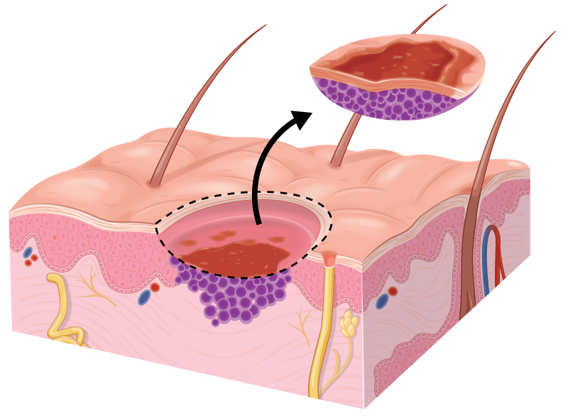 Diagram of Mohs surgery at 1st stage