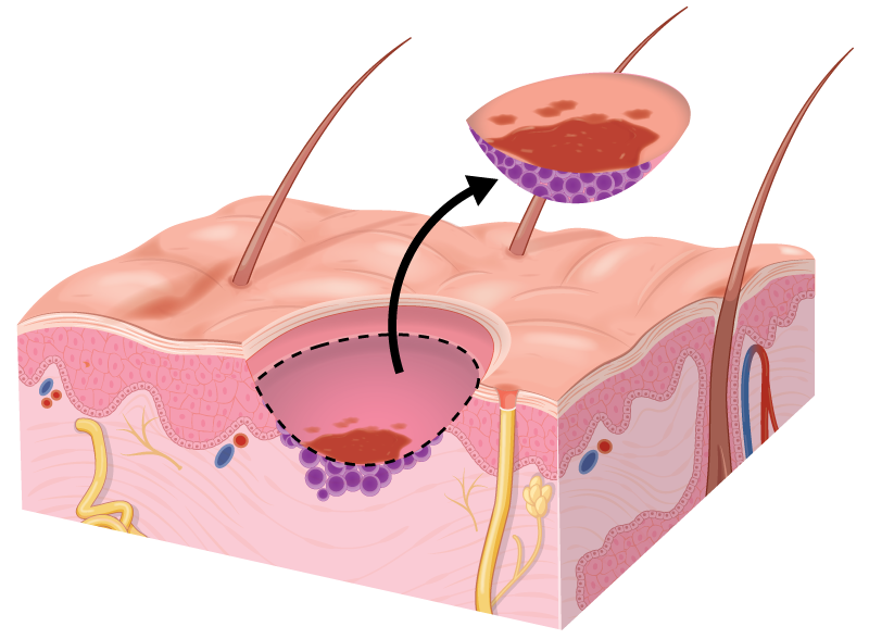 Diagram of Mohs surgery at 2nd stage