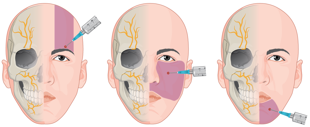 Guide to Local Anaesthetic - Skintel