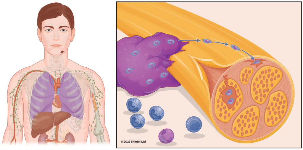 Diagram of perineural invasion from skin cancer