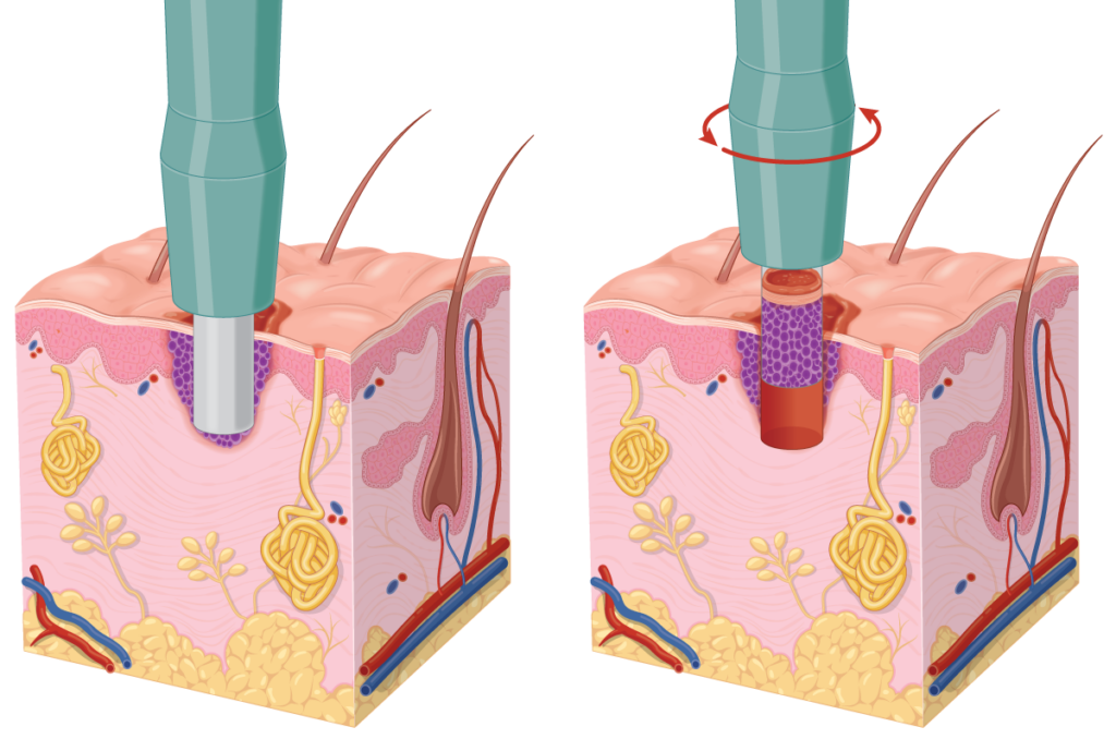 Illustration of punch biopsy before and after.