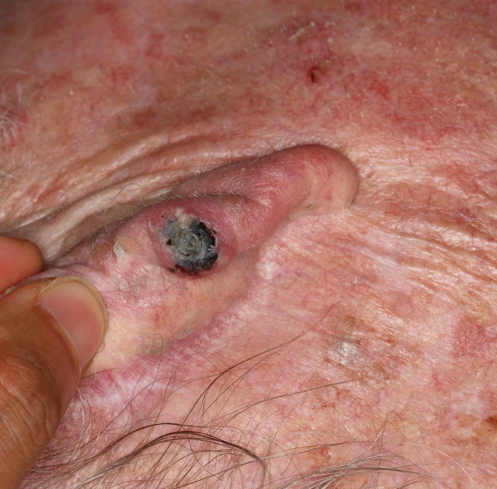 Photo of squamous cell carcinoma (SCC) on ear