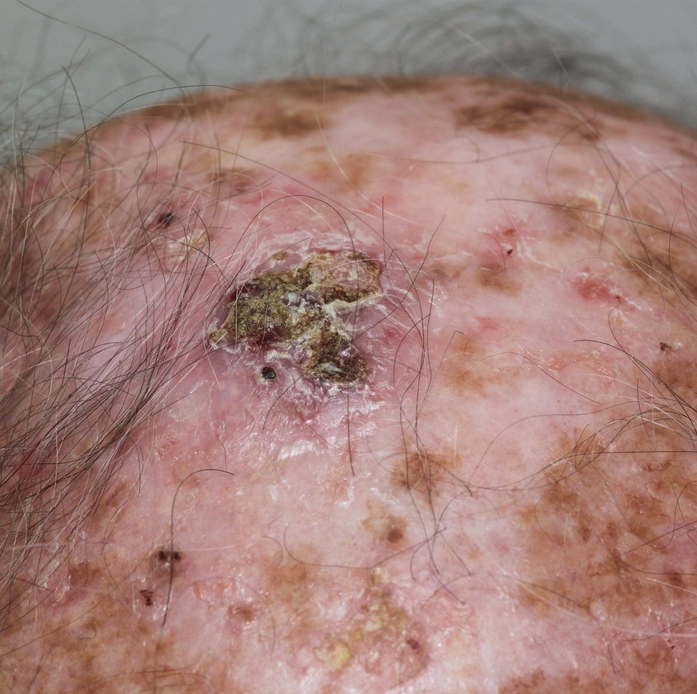 Photo of squamous cell carcinoma (SCC) on scalp