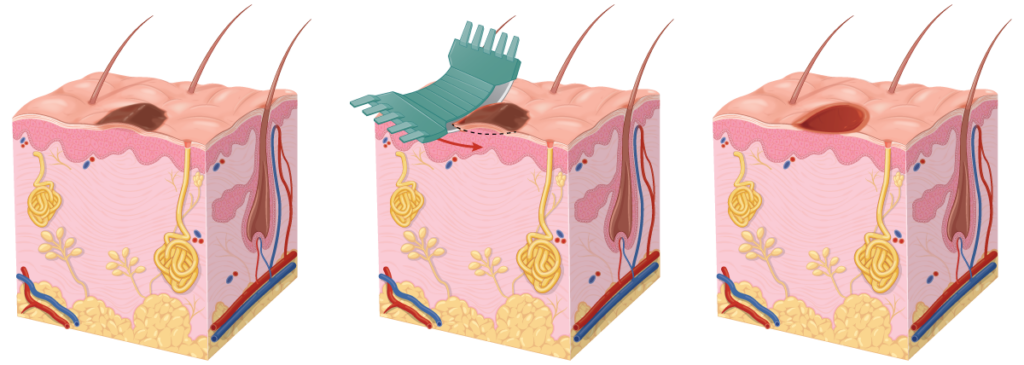 Diagram of three steps of shave excision and biopsy procedure.