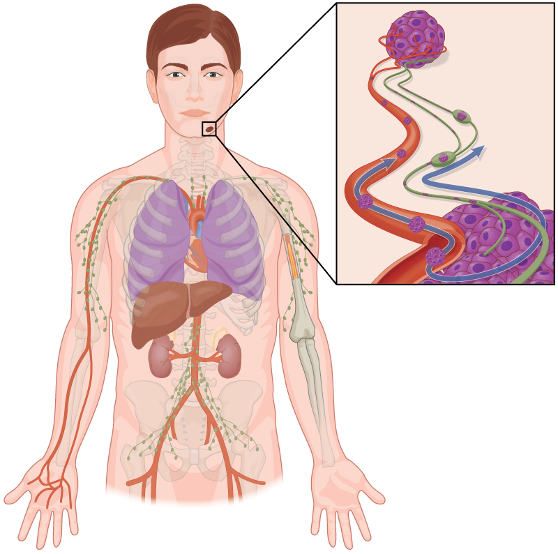 Diagram of skin cancer metastatic spread