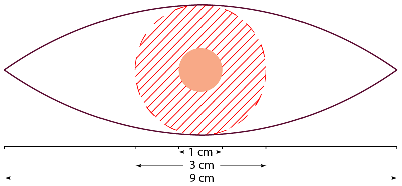 Diagram of 10 mm surgical margins