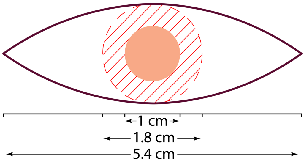 Diagram of 4 mm surgical margins