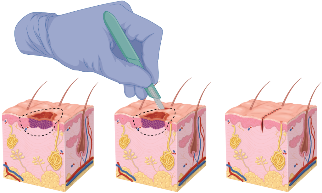 Wide Local Excision Illustration. Skin cancer removal.