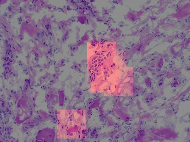 Artificial intelligence (AI) detection of basal cell carcinoma (BCC) histology.