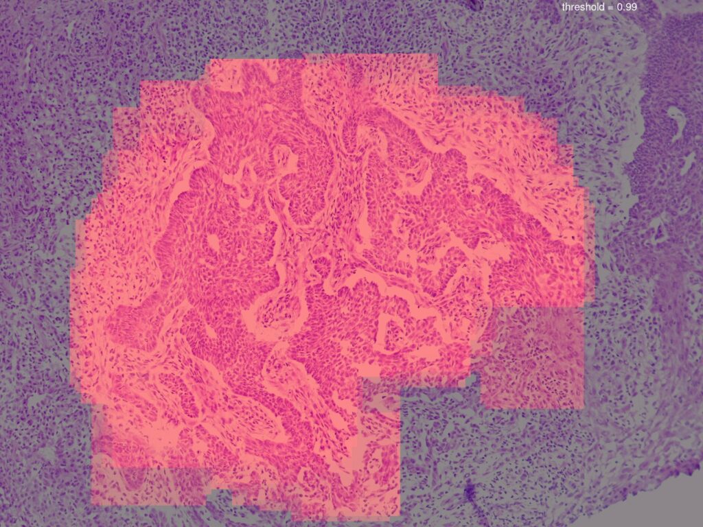 Artificial intelligence (AI) detection of basal cell carcinoma (BCC) histology.