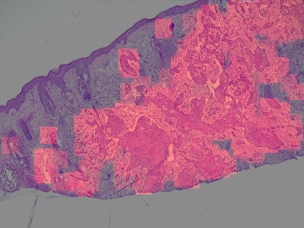 Artificial intelligence (AI) detection of basal cell carcinoma (BCC) histology.