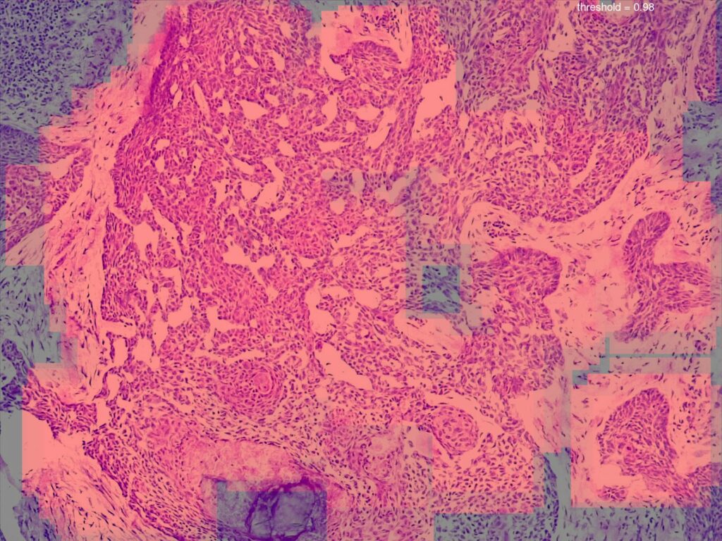 Artificial intelligence (AI) detection of basal cell carcinoma (BCC) histology.