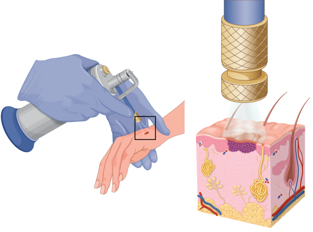 Diagram of cryotherapy