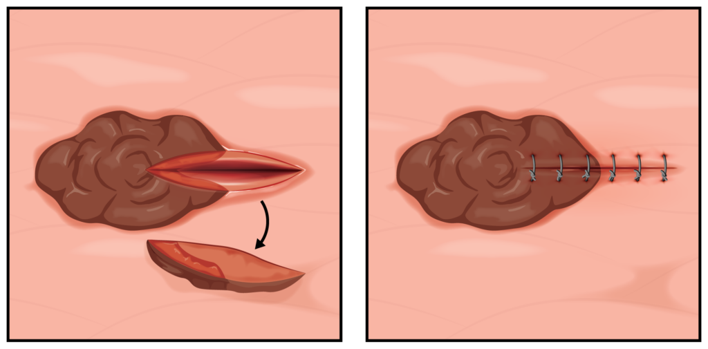 Diagram of an incisional skin biopsy.