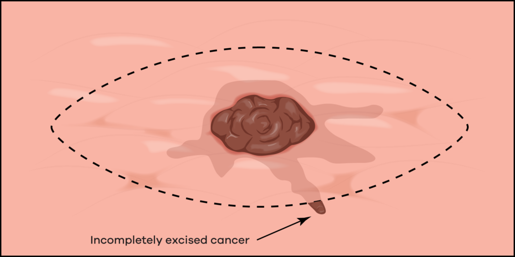 Diagram of incomplete excision in 2 dimensions