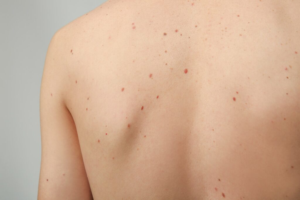 Photo of back with numerous moles (naevi)