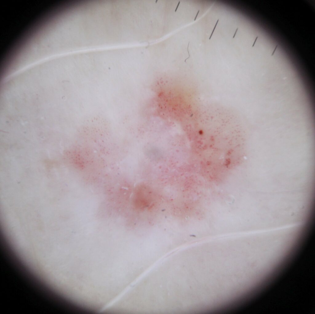 Dermoscopy photo of squamous cell carcinoma in situ (SCCis) under a dermatoscope.